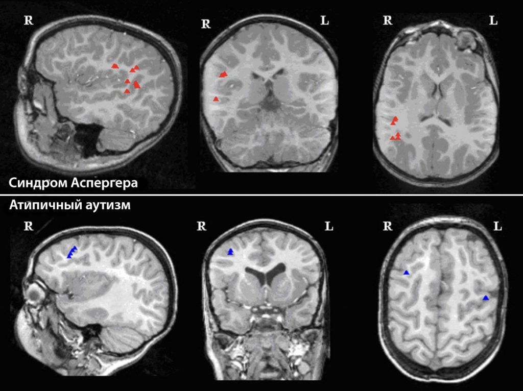 Изображение диполей МЭГ на снимках МРТ в случае синдрома Аспергера по сравнению с PDD-NOS (треугольники: диполи 
пароксизмальной ритмической активности).