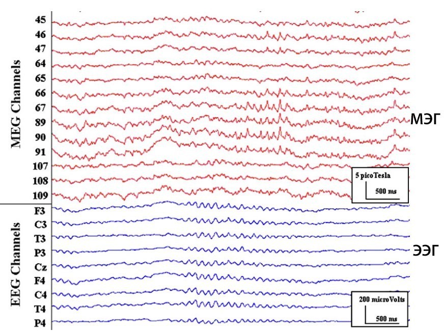  Запись МЭГ – ЭЭГ, показывающая пароксизмальную ритмическую активность на частоте 9 Гц, видимую исключительно на записи МЭГ. Правые лобно-височные каналы МЭГ (верхняя
кривая красным) и монополярный монтаж каналов ЭЭГ с Cz в качестве эталона (нижняя кривая синим цветом).